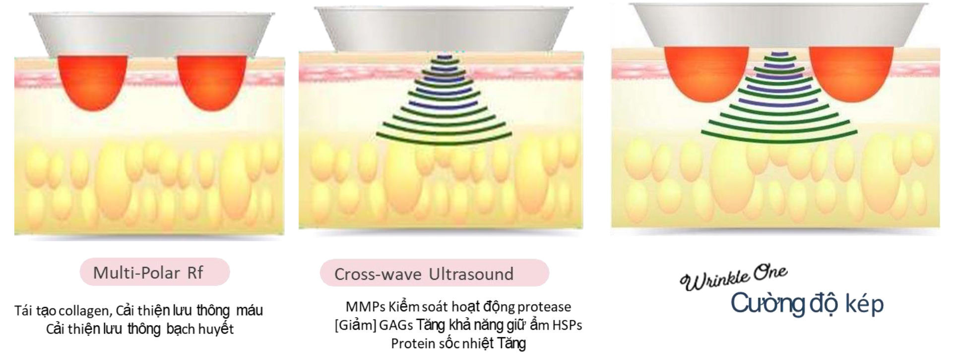 Cường độ kép RF và Ultrasound